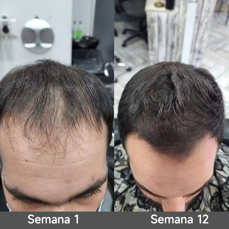 🌿👨‍⚕️ Tienda oficial en EE. UU. 🇺🇸 | 🔥 Champú y acondicionador 2 en 1 PURELORA® de cebolla y romero con complejo activo 15X para el crecimiento capilar: para un cabello con apariencia más gruesa, abundante y fuerte.