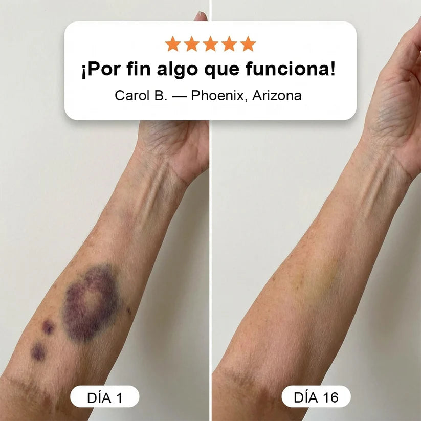 💥Más de 100.000 unidades vendidas💕 - Crema PURELORA® para reparar hematomas y fortalecer la piel