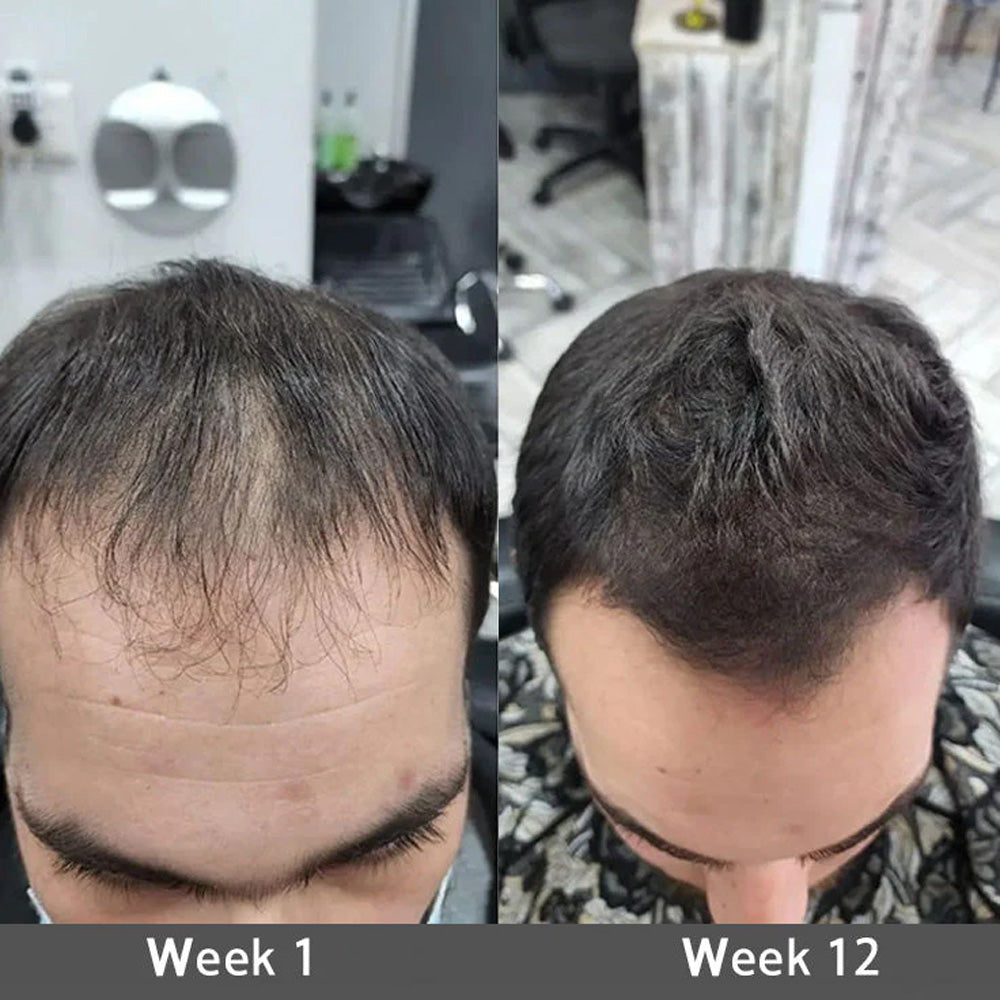 🌿👨‍⚕️ Official US Store 🇺🇸 | 🔥 PURELORA® Onion & Rosemary 2-in-1 Shampoo & Conditioner with 15X Active Complex for Hair Growth: For hair that looks thicker, fuller, and stronger