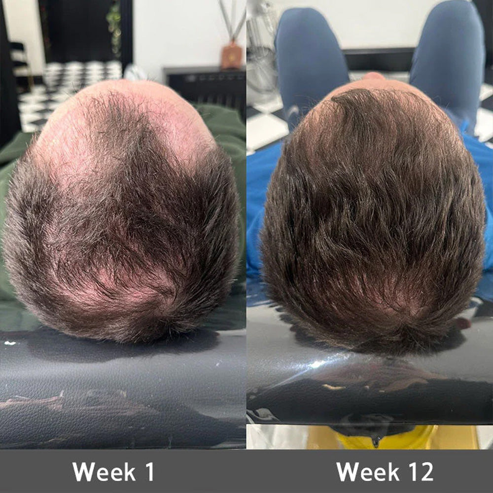 🌿👨‍⚕️ Official US Store 🇺🇸 | 🔥 PURELORA® Onion & Rosemary 2-in-1 Shampoo & Conditioner with 15X Active Complex for Hair Growth: For hair that looks thicker, fuller, and stronger