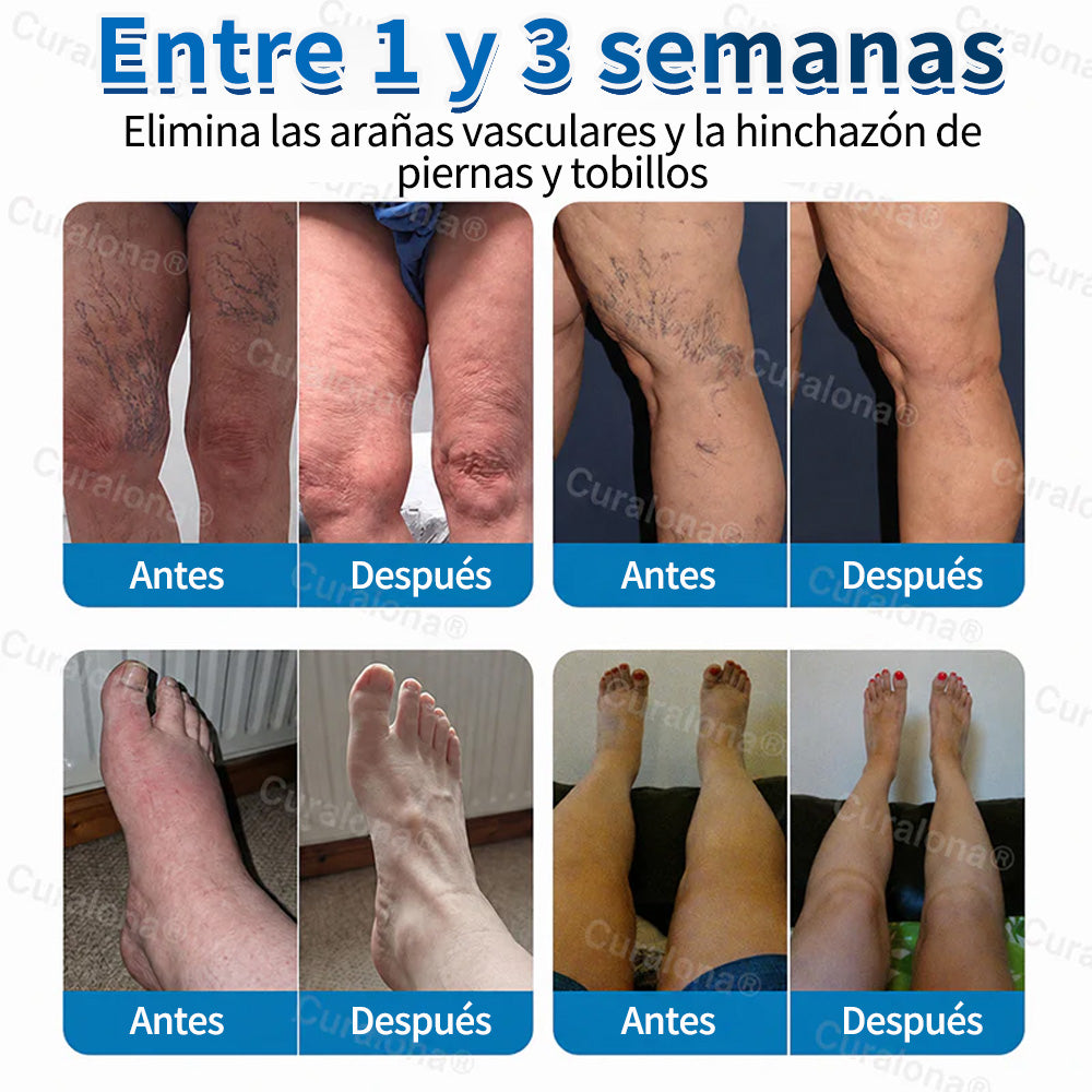 🇺🇸🏆✅️🏃 Rollo de parches de microagujas Curalona® VeinRepair ⚡ Alivio inmediato, resultados a largo plazo