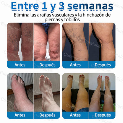 🇺🇸🏆✅️🏃 Rollo de parches de microagujas Curalona® VeinRepair ⚡ Alivio inmediato, resultados a largo plazo