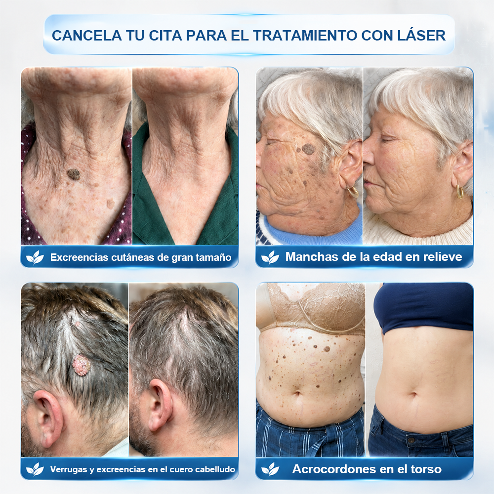 PURELORA®👩‍⚕️ Eliminación de imperfecciones sin dolor y sin cicatrices mediante rodillo.