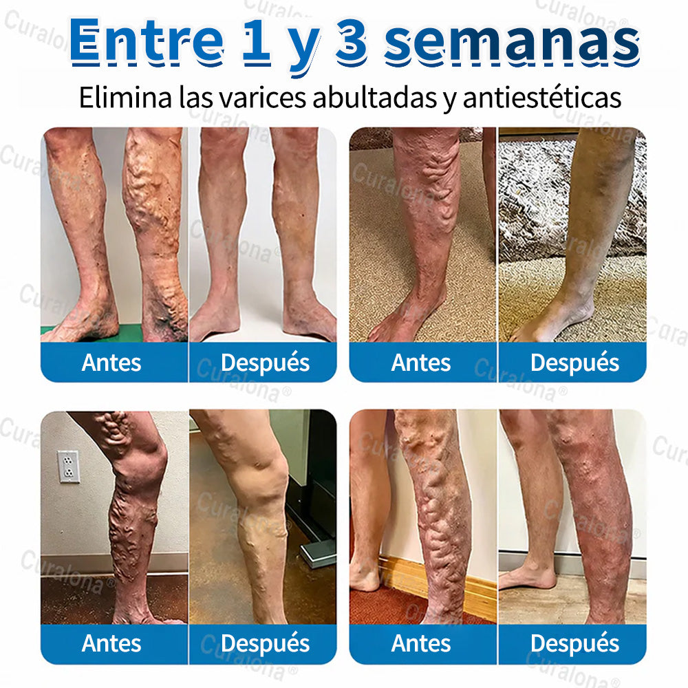 🇺🇸🏆✅️🏃 Rollo de parches de microagujas Curalona® VeinRepair ⚡ Alivio inmediato, resultados a largo plazo