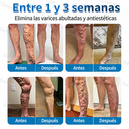 🇺🇸🏆✅️🏃 Rollo de parches de microagujas Curalona® VeinRepair ⚡ Alivio inmediato, resultados a largo plazo