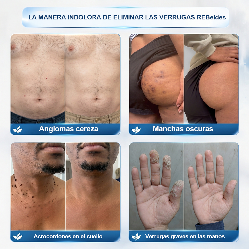 PURELORA®👩‍⚕️ Eliminación de imperfecciones sin dolor y sin cicatrices mediante rodillo.