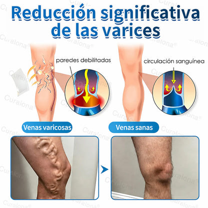 🇺🇸🏆✅️🏃 Rollo de parches de microagujas Curalona® VeinRepair ⚡ Alivio inmediato, resultados a largo plazo