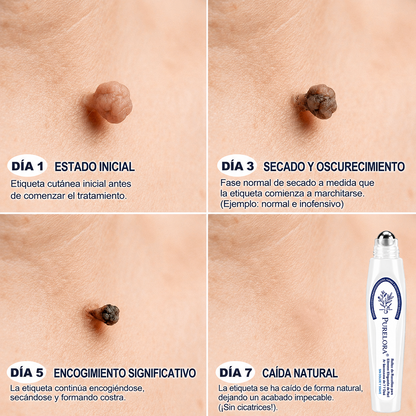 PURELORA®👩‍⚕️ Eliminación de imperfecciones sin dolor y sin cicatrices mediante rodillo.